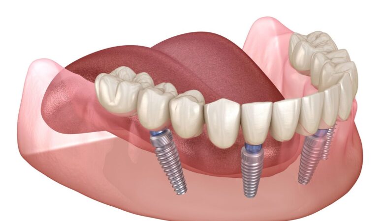 Τι είναι τα οδοντικά εμφυτεύματα All-on-4
